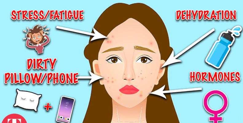 Types of acne