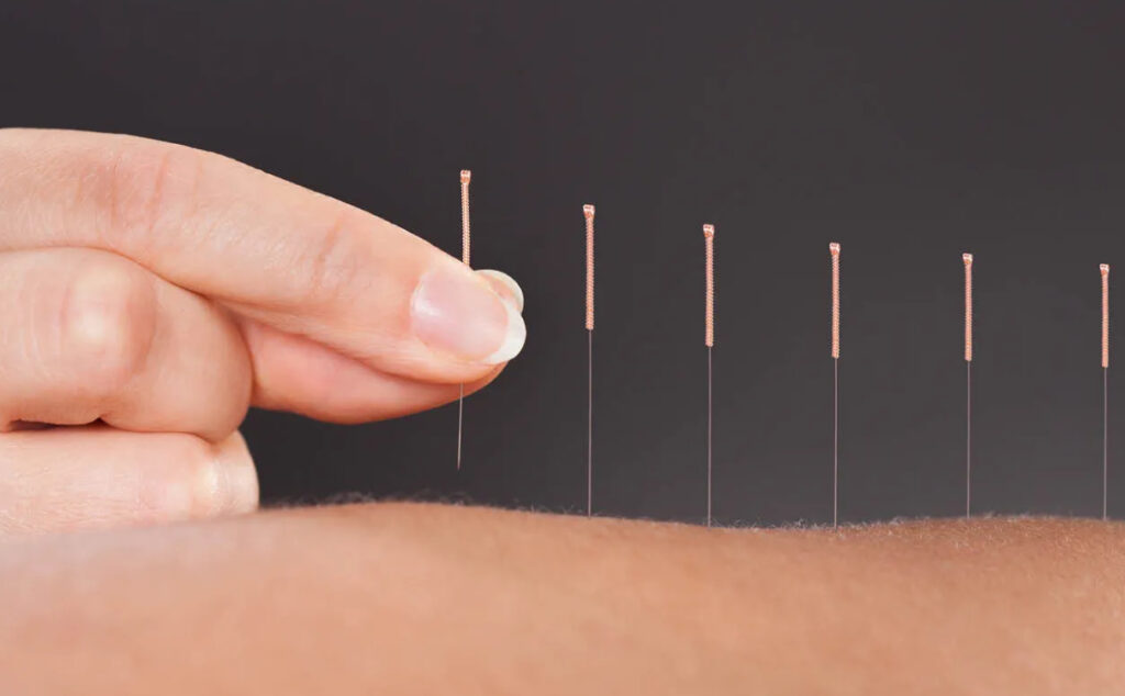 Acupuncture treatment