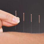 Acupuncture treatment