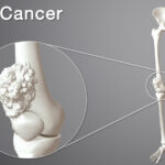 Bone Cancer