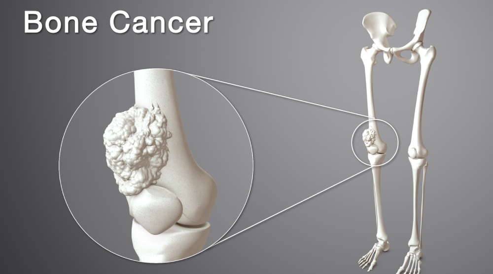 Bone Cancer