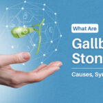 Gallstones