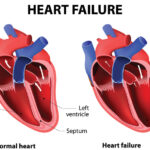 Heart failure