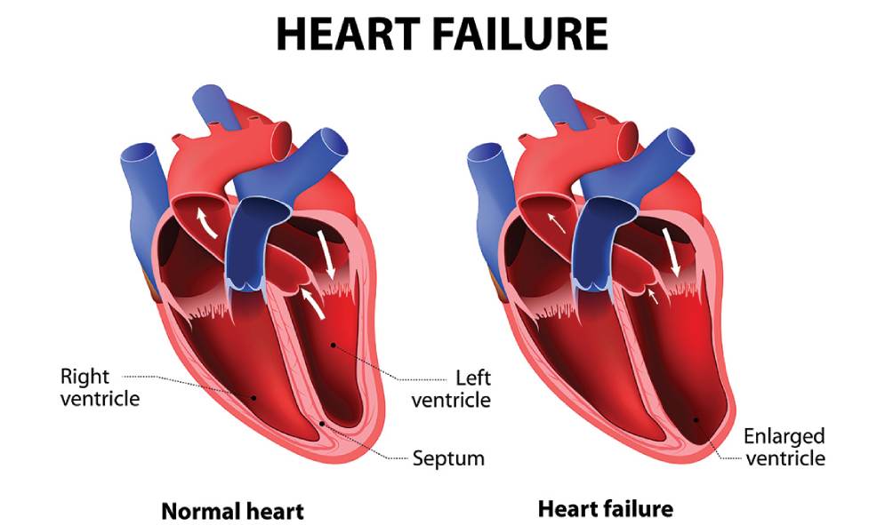 Heart failure