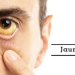 Jaundice