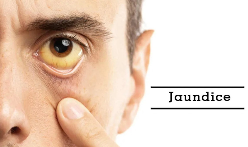 Jaundice