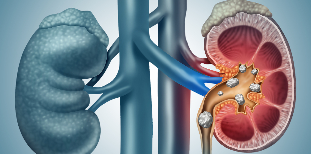 Kidney stones