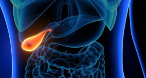 Stones in the gall bladder