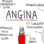 angina
