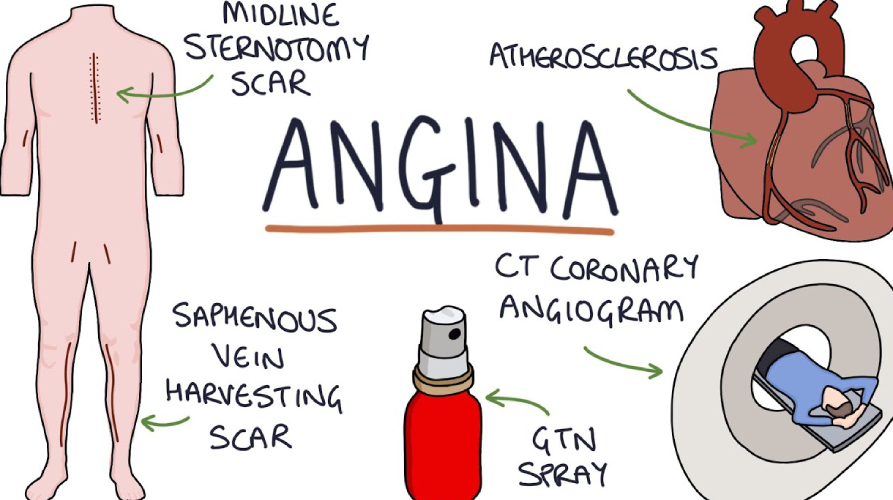 angina