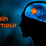 brain tumor