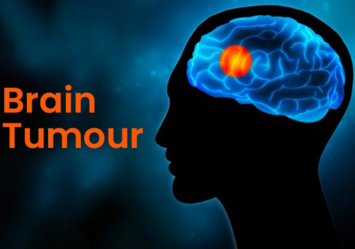 brain tumor