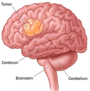 brain tumor 