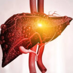 Cirrhosis
