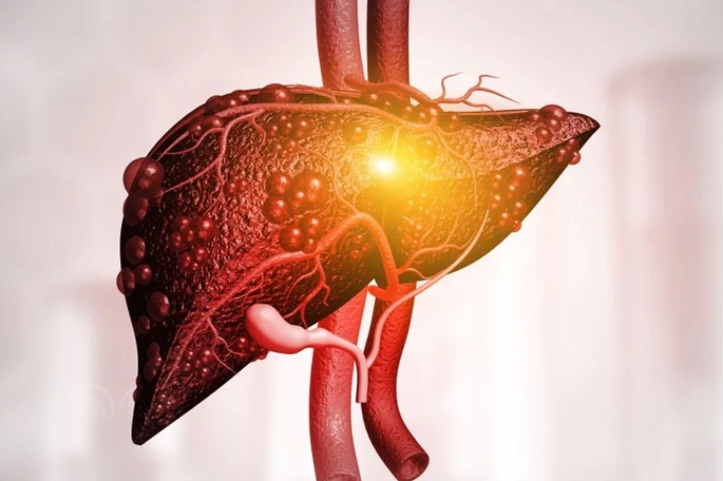 Cirrhosis