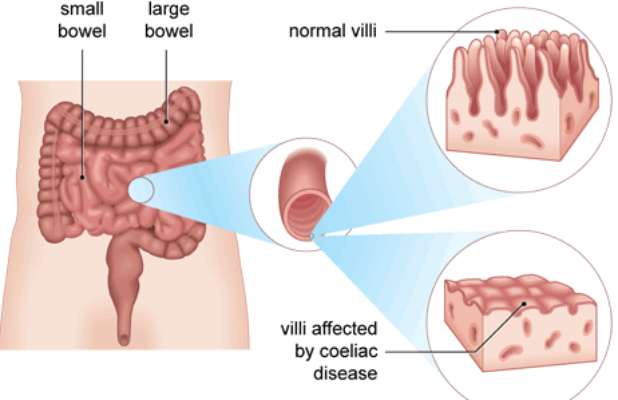 celiac cancer