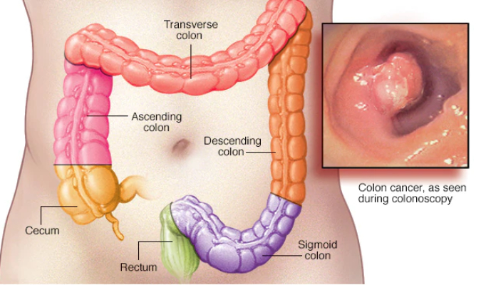colon cnacer