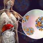 Hepatitis B