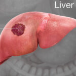 liver-cancer