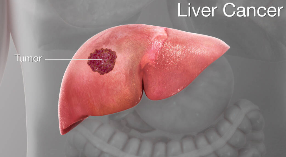 liver-cancer