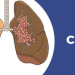 lung cancer