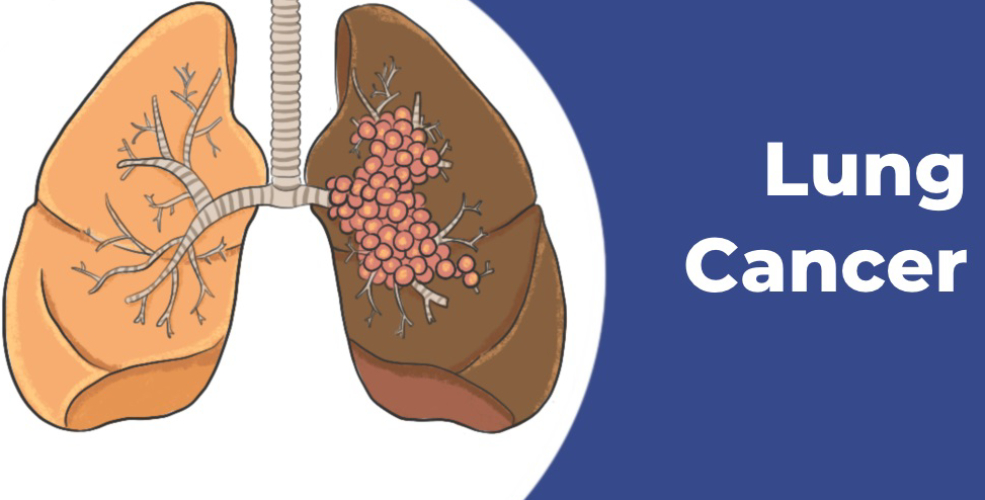 lung cancer