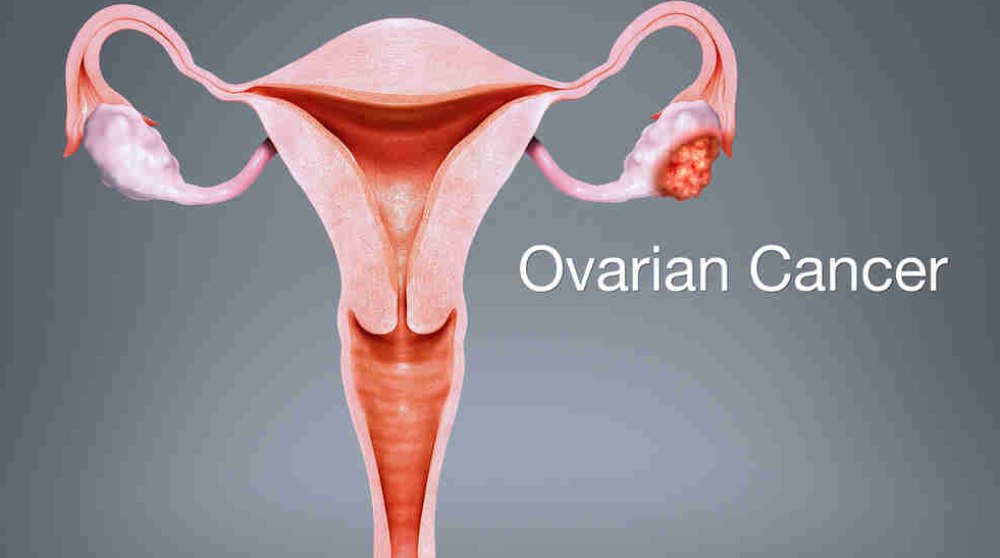 ovarian cancer