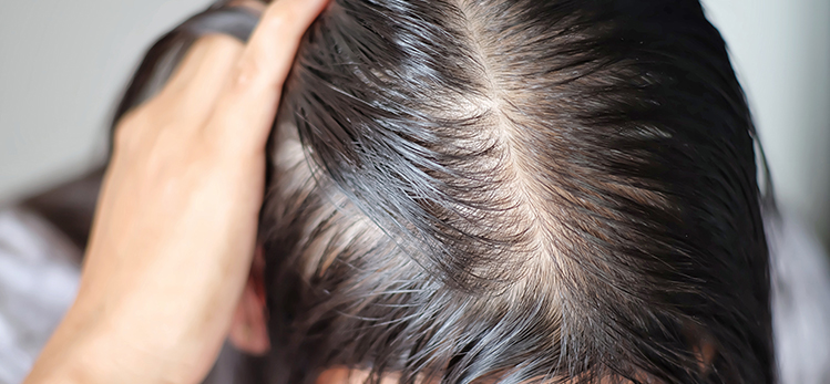 Causes of Thinning Hair